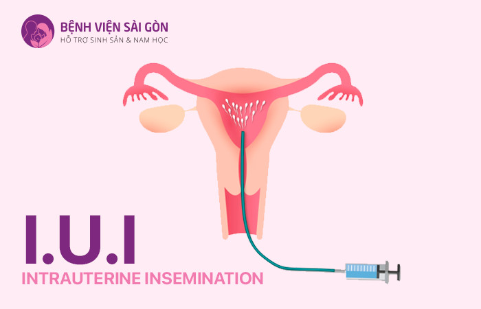 IUI là phương pháp hỗ trợ sinh sản phổ biến điều trị vô sinh hiếm muộn