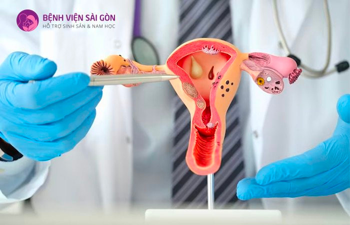 Lạc nội mạc tử cung ở nữ giới là biến chứng của u nang buồng trứng
