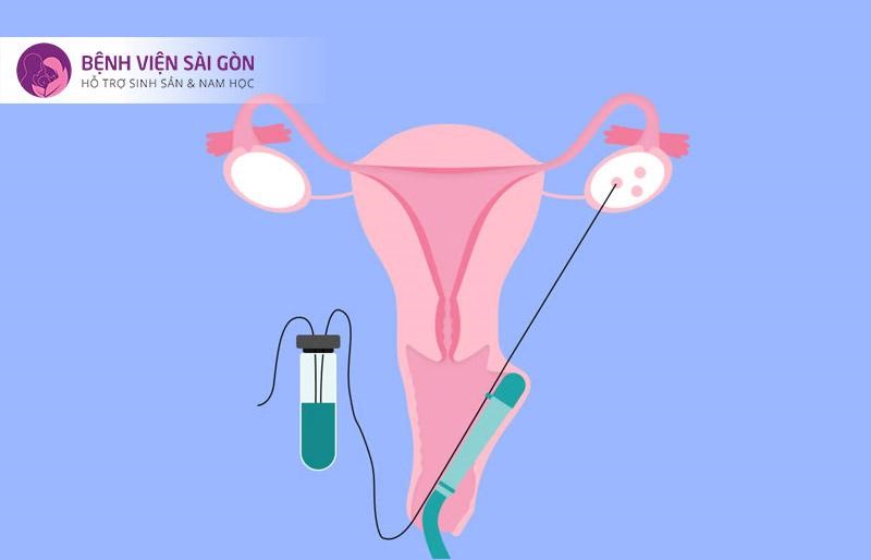 Kỹ thuật chọc hút trứng Kỹ thuật chọc hút trứng
