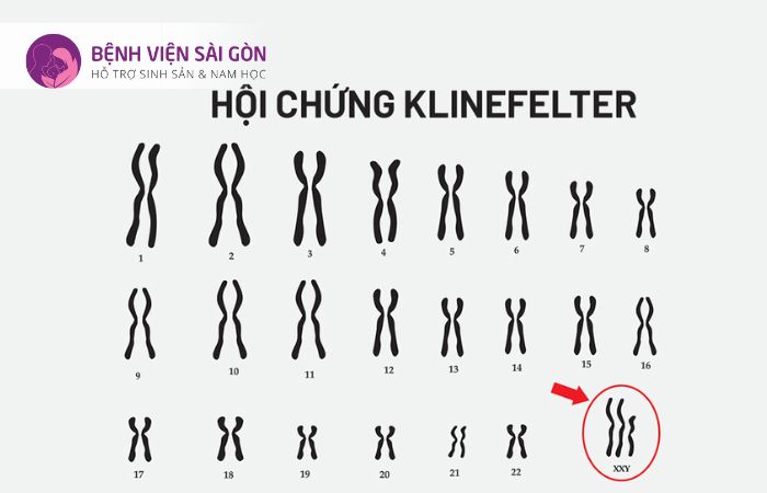 Yếu tố di truyền hội chứng Klinefelter Yếu tố di truyền hội chứng Klinefelter