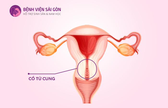 Viêm cổ tử cung có thể gây ra tình trạng co thắt âm đạo ở nữ giới