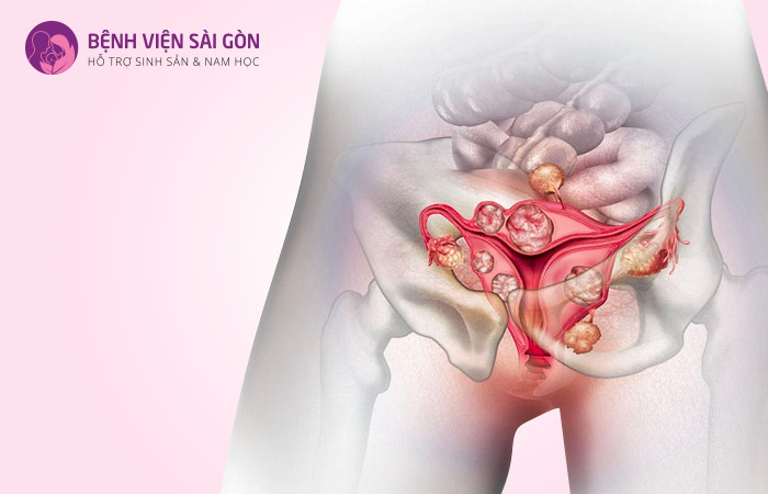 Polyp tử cung thường xuất hiện ở lớp niêm mạc tử cung