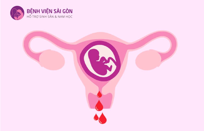 U xở tử cung là nguyên nhân gây ra sảy thai 