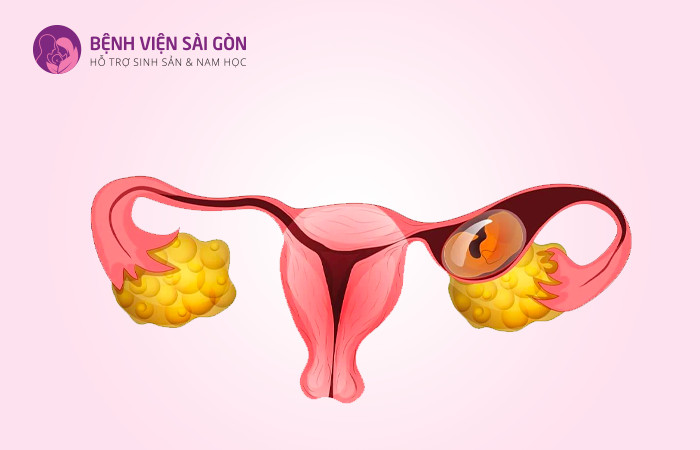 Nếu thai không di chuyển ra khỏi vòi trứng sẽ xảy ra tình trạng thai ngoài tử cung