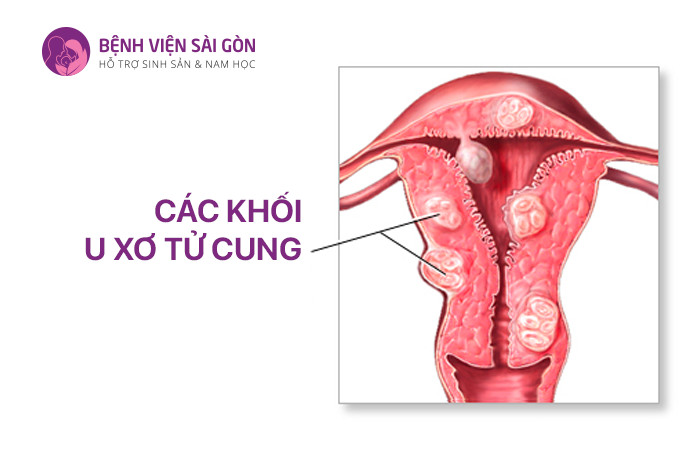 U xơ tử cung là những khối u phát triển bên trong tử cung của phụ nữ