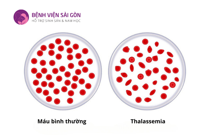 Thalassemia là bệnh di truyền liên quan đến chức năng đông máu