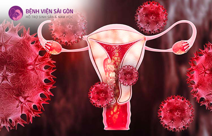 Vi khuẩn sùi mào gà HPV 16 và HPV 18 thuộc gây ung thư cổ tử cung
