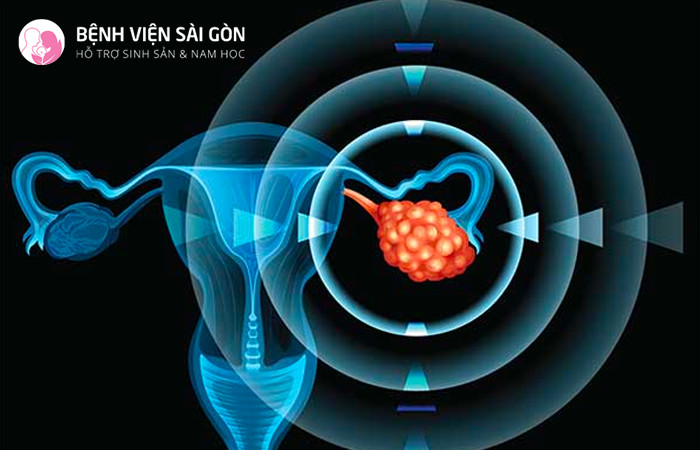 Ung thư buồng trứng - Ovarian Cancer là bệnh lý xuất hiện ở nữ giới