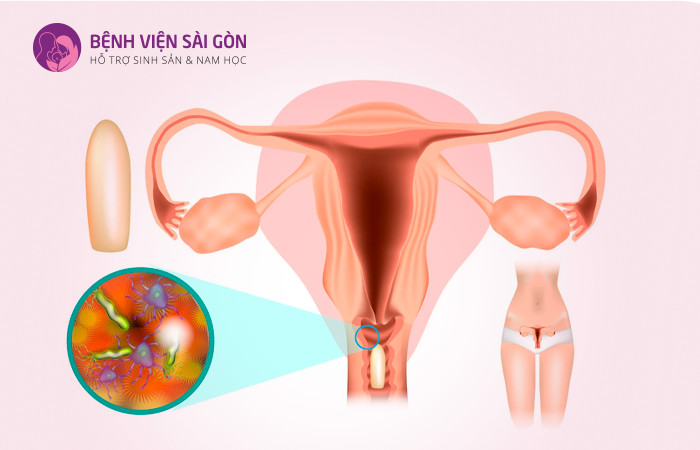 Viêm âm đạo ở nữ giới là do mất cân bằng hệ vi khuẩn ở âm đạo