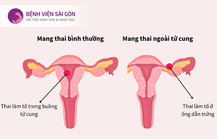 Thai ngoài tử cung là tình trạng thai làm tổ và phát triển ở bên ngoài buồng tử cung