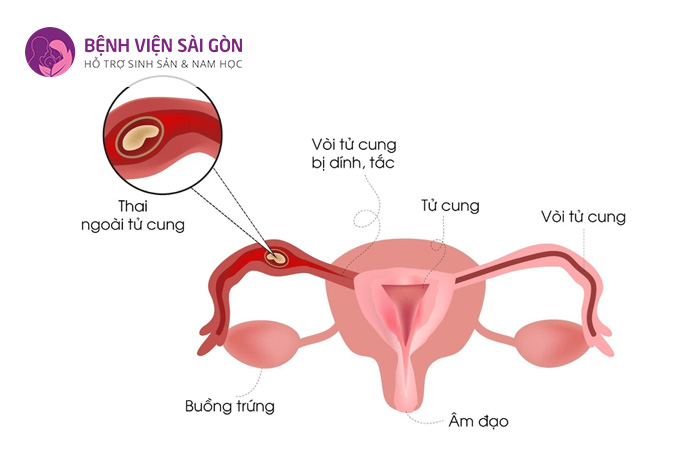 Vòi tử cung bị dính tắc gây ra tình trạng thai ngoài tử cung