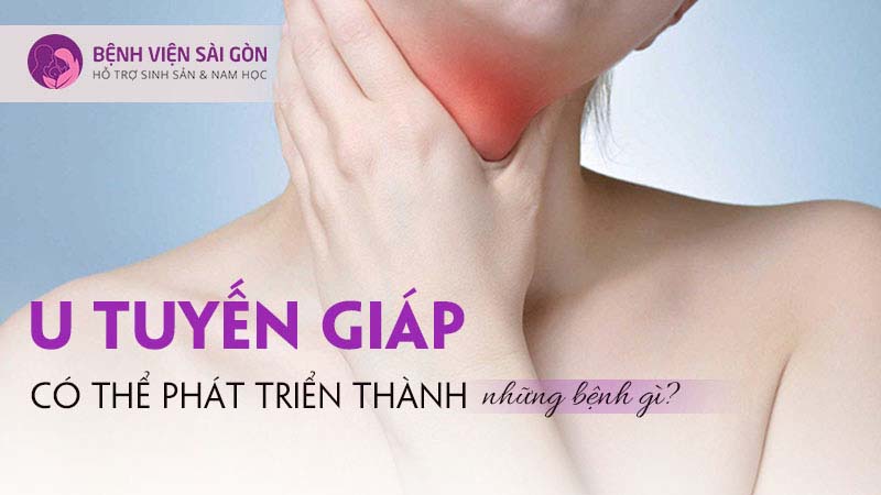 U tuyến giáp có thể phát triển thành những bệnh gì