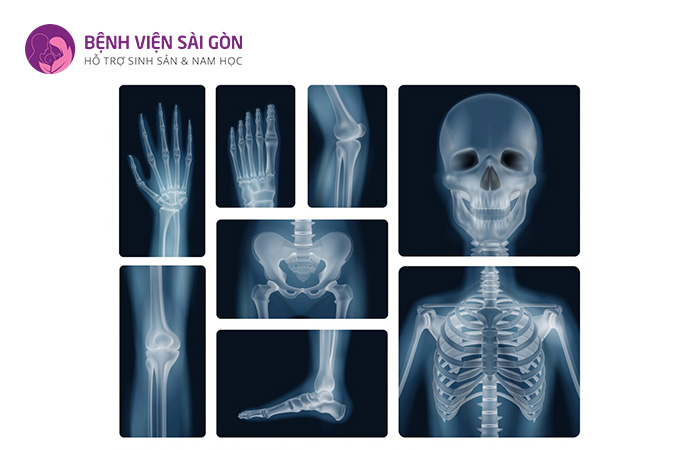 Chụp X-quang thường được sử dụng để chẩn đoán xương gãy