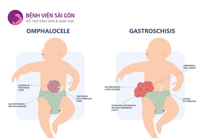 Gastroschisis - Đây là một khuyết tật bẩm sinh của thành bụng
