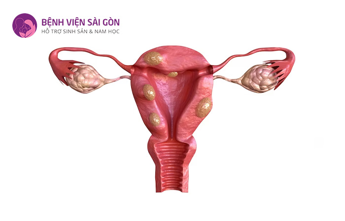 U xơ tử cung là nguyên nhân gây ra rong kinh ở những người tầm 30 - 40 tuổi