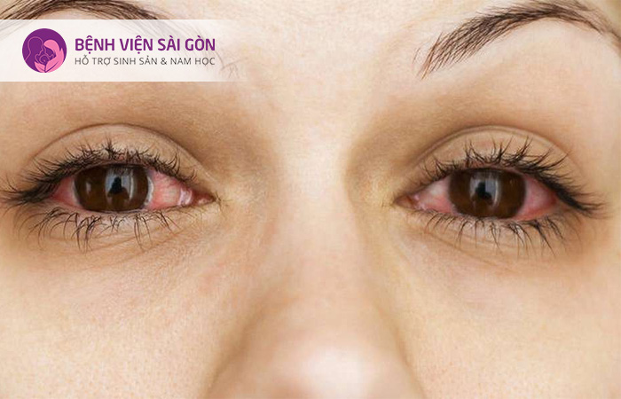 Hội chứng Sjogren xảy ra khi hệ thống miễn dịch tấn công các tuyến tạo ra nước mắt và nước bọt