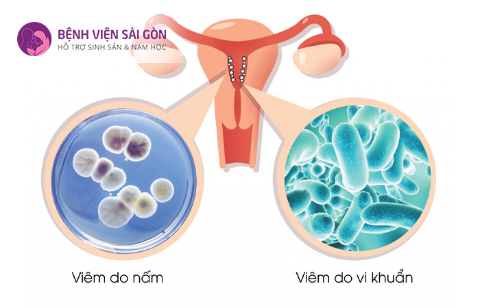 Polyp tử cung là một trong những nguyên nhân dẫn đến viêm phụ khoa