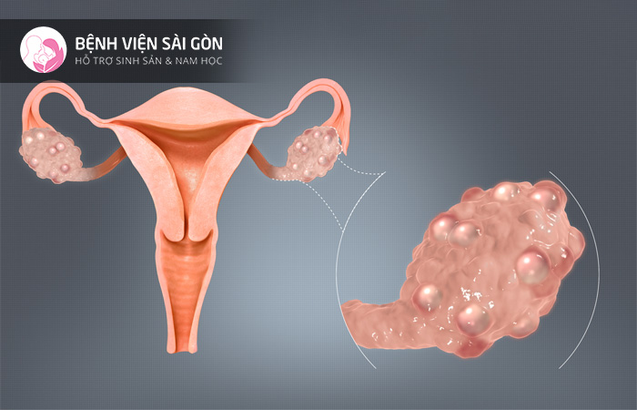 Đa nang buồng trứng là nguyên nhân khiến niêm mạc tử cung mỏng