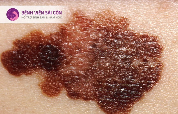 Da bị tổn thương không rõ nguyên nhân và có màu bất thường thể là dấu hiệu của ung thư da