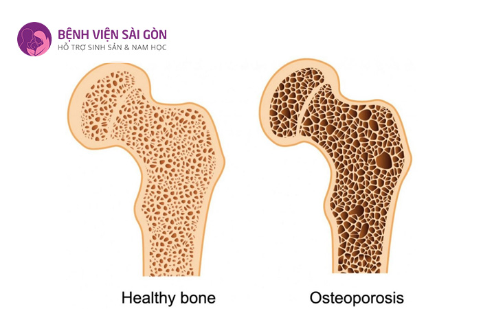 Bệnh loãng xương là bệnh lý suy giảm mật độ khoáng chất và cấu trúc trong xương