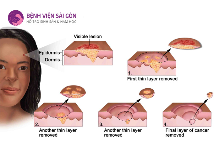 Phẫu thuật Mohs được áp dụng trong điều trị ung thư da