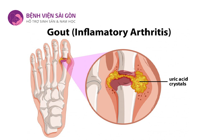 Triệu chứng của bệnh gout là làm cho các khớp trong hệ xương bị viêm