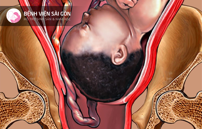 Sa dây rốn làm ngăn chặn oxy cung cấp cho thai nhi