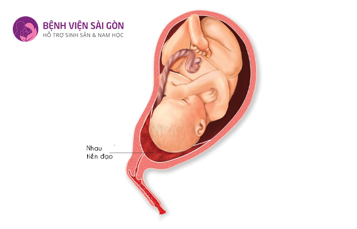Mẹ bầu bị viêm phụ khoa hoặc mang đa thai thì có nguy cơ cao mắc nhau tiền đạo