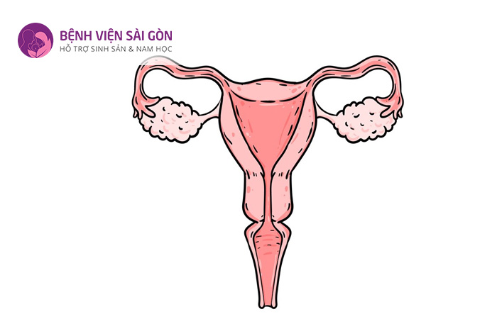 Viêm nội mạc tử cung là một trong những biến chứng của nhiễm trùng ối
