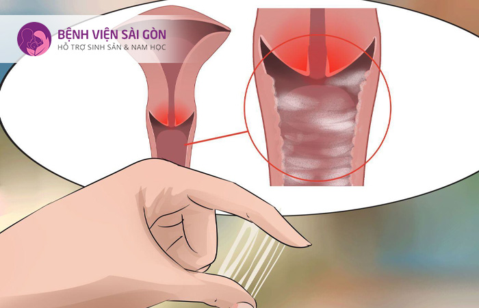 Tiết dịch bất thường là một trong những triệu chứng của tình trạng nhiễm trùng âm đạo