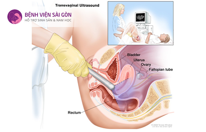 Siêu âm đầu dò là phương pháp dùng để đánh giá buồng trứng và tử cung qua ngả âm đạo