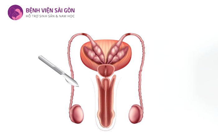 Thắt ống dẫn tinh (triệt sản nam) là phương pháp ngăn chặn tinh trùng tiếp cận âm đạo