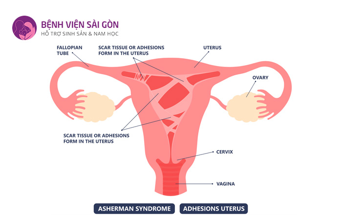 Dính buồng tử cung gây ra các biến chứng nguy hiểm gây ảnh hưởng đến sức khoẻ