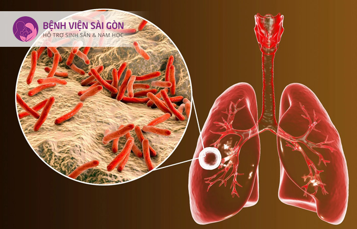 Mycobacterium là vi khuẩn gây ra bệnh lao phổi ở con người