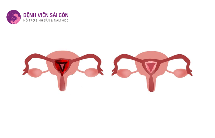 Viêm nội mạc tử cung là tình trạng buồng tử cung bị viêm nhiễm