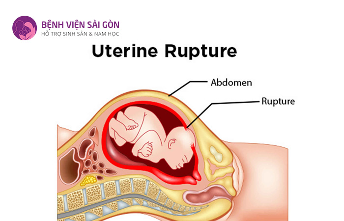 Vỡ tử cung là tình trạng lớp cơ tử cung bị nứt hoặc rách hoàn toàn mà không do phẫu thuật