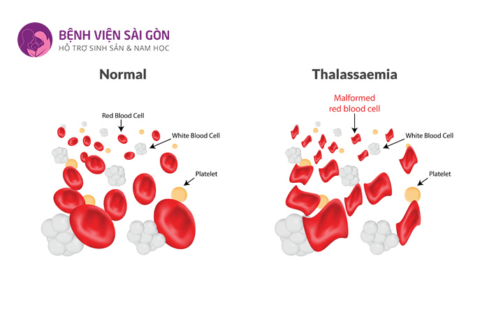 Thalassemia là một trong những bệnh di truyền phổ biến nhất hiện nay