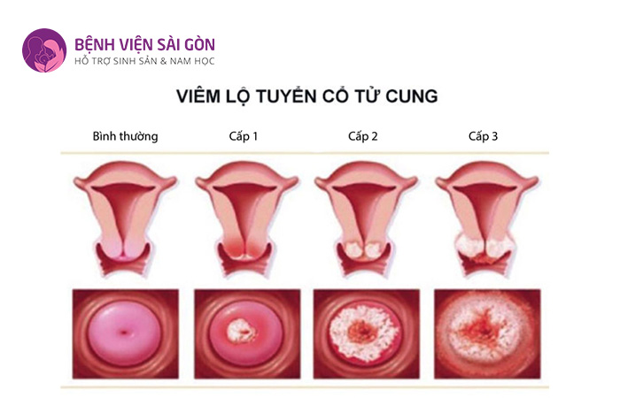 Viêm lộ tuyến là một trong những dạng tổn thương cổ tử cung thường gặp