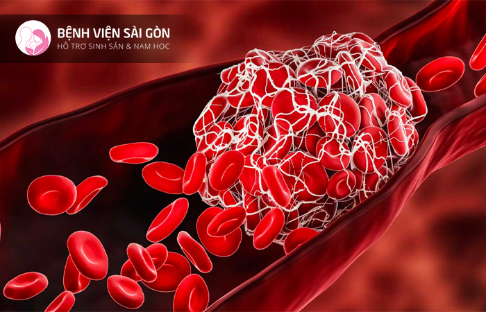 Rối loạn đông máu là tình trạng thường gặp trong băng huyết sau sinh do mất máu quá nhiều