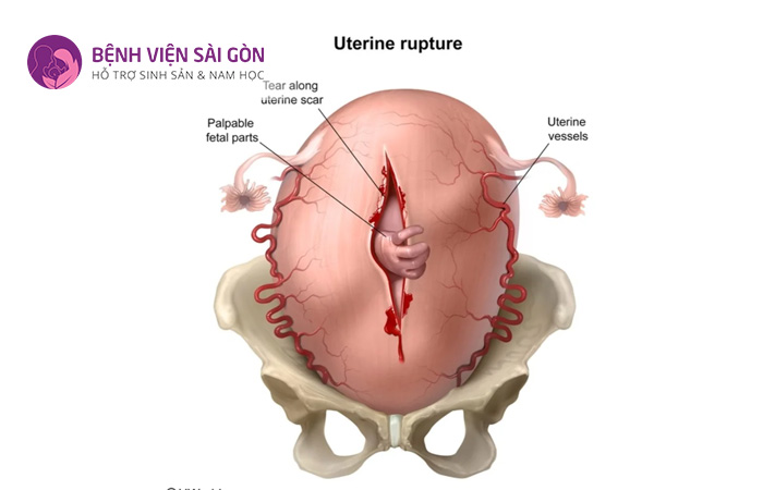 Vỡ tử cung trong quá trình chuyển dạ có thể dẫn đến mất tim thai