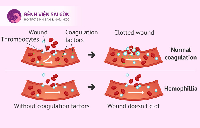 Bệnh máu khó đông là bệnh di truyền do đột biến trên nhiễm sắc thể X