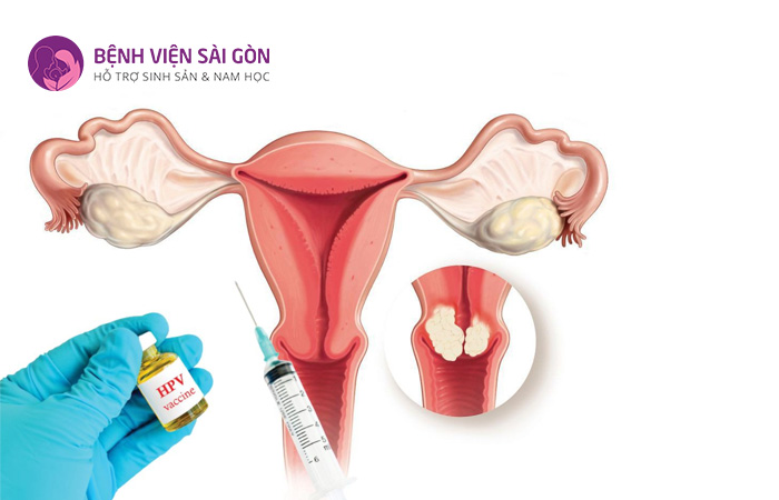 Phòng ngừa HPV là một cách giảm thiểu tình trạng tổn thương cổ tử cung