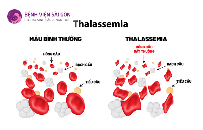 Xét nghiệm di truyền tiền làm tổ PGT-M giúp phát hiện bệnh Thalassemia