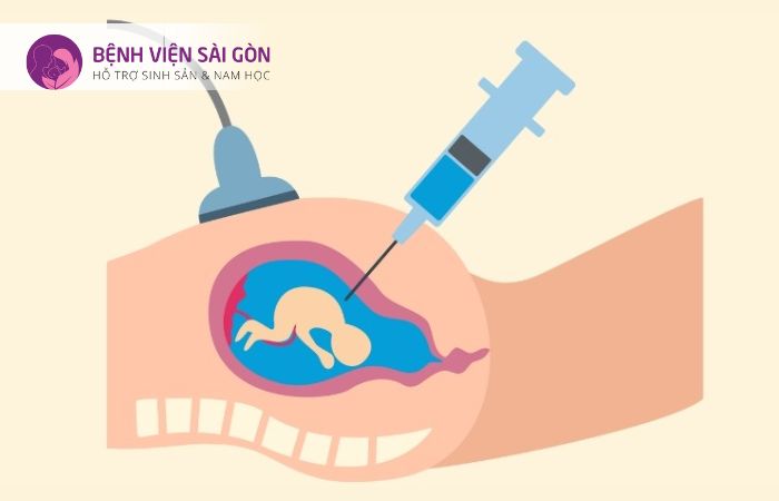 Thủ thuật chọc ối có nguy hiểm không Thủ thuật chọc ối có nguy hiểm không