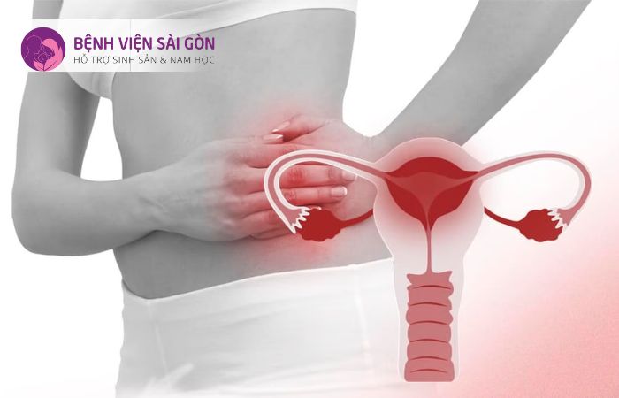 Viêm nhiễm vùng chậu Viêm nhiễm vùng chậu