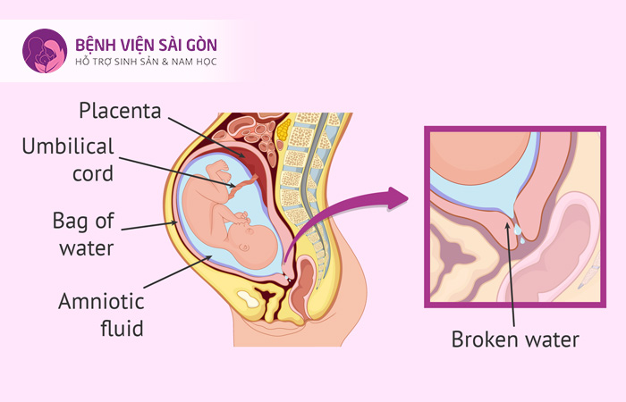 Vỡ ối non là tình người mẹ vỡ ối trước khi chuyển dạ