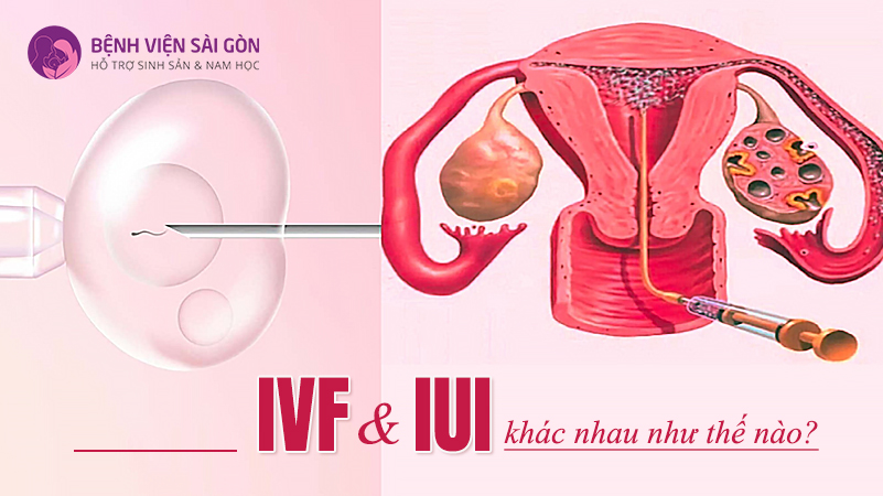 IUI và IVF khác nhau như thế nào?