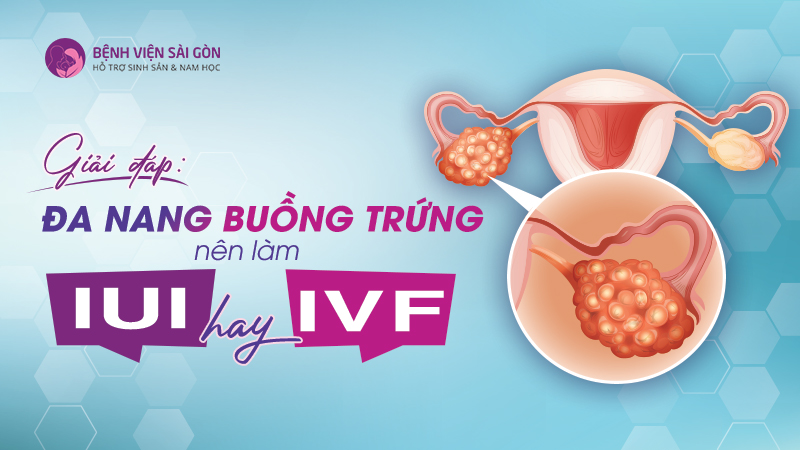 Giải đáp: Đa nang buồng trứng nên làm IUI hay IVF