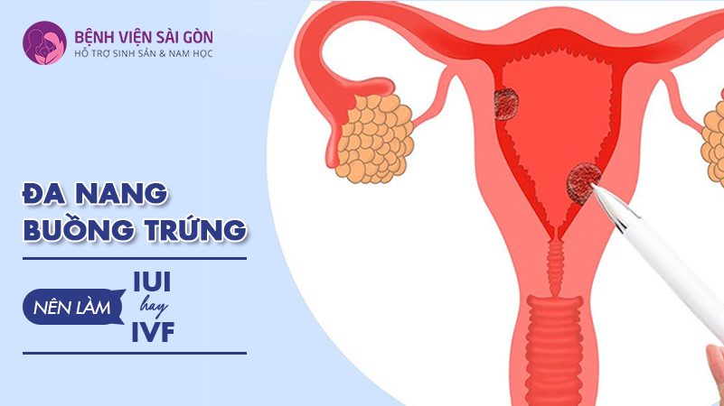 Đa nang buồng trứng nên làm IUI hay IVF?