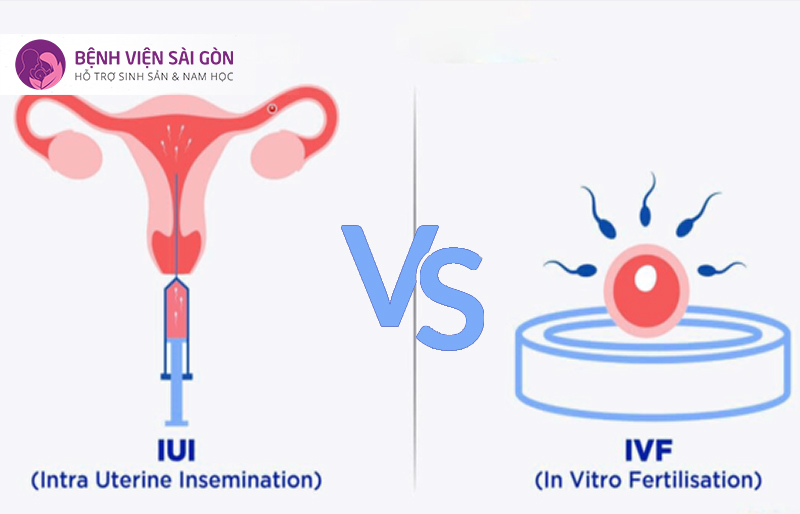 IUI và IVF